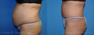 Patient 20b Tummy Tuck Before and After