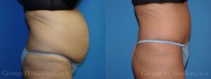 Patient 20c Tummy Tuck Before and After