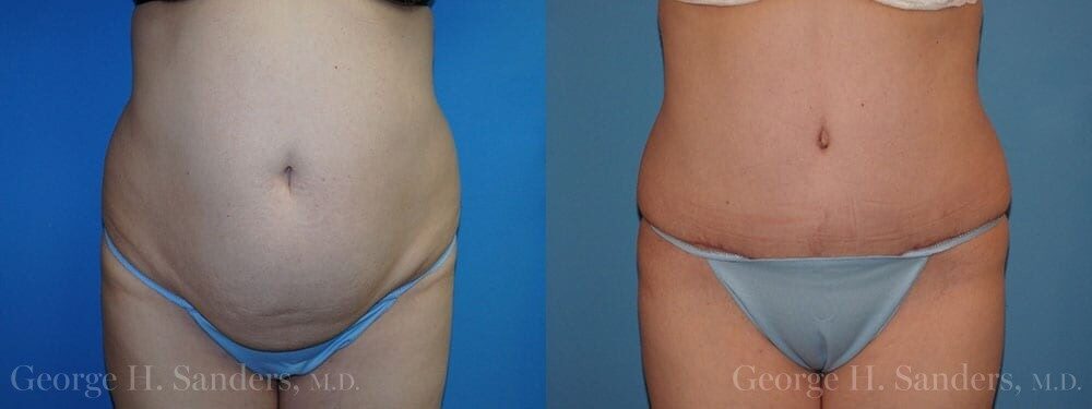 Patient 21a Tummy Tuck Before and After