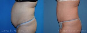 Patient 21b Tummy Tuck Before and After