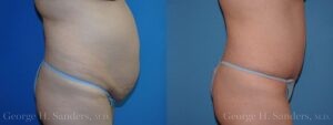Patient 21c Tummy Tuck Before and After