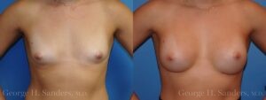 Patient 24a Breast Augmentation Before and After