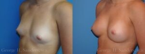 Patient 24b Breast Augmentation Before and After