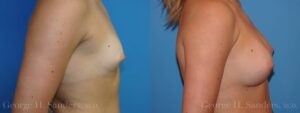Patient 24c Breast Augmentation Before and After