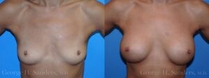 dr-sanders-los-angeles-breast-augmentation-patient-25-1