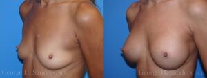 dr-sanders-los-angeles-breast-augmentation-patient-25-2