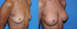 dr-sanders-los-angeles-breast-augmentation-patient-25-3