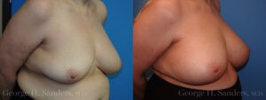 Patient 12c Breast Capsules Before and After
