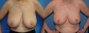 Patient 15a Breast Reduction Before and After