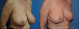 Patient 15b Breast Reduction Before and After