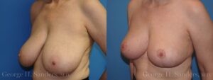 Patient 15c Breast Reduction Before and After