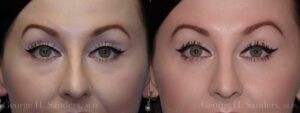 Patient 14a Eyelid Surgery Before and After