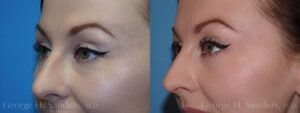 Patient 14c Eyelid Surgery Before and After