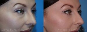 Patient 14d Eyelid Surgery Before and After