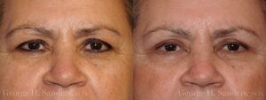 Patient 15a Eyelid Surgery Before and After