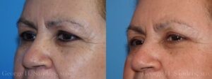 Patient 15b Eyelid Surgery Before and After
