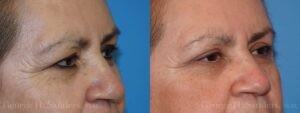 Patient 15c Eyelid Surgery Before and After