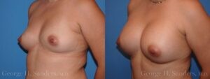 dr-sanders-los-angeles-breast-augmentation-patient-27-2