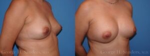 dr-sanders-los-angeles-breast-augmentation-patient-27-3