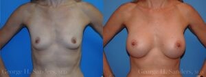 dr-sanders-los-angeles-breast-augmentation_patient-26-1