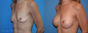 dr-sanders-los-angeles-breast-augmentation_patient-26-2
