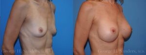 dr-sanders-los-angeles-breast-augmentation_patient-26-3