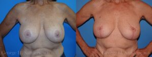dr-sanders-los-angeles-breast-capsules_patient-13-1