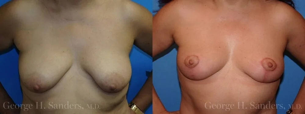 dr-sanders-los-angeles-breast-lift-patient-12-1