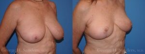 dr-sanders-los-angeles-breast-reduction_patient-16-2