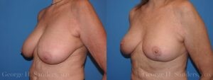 dr-sanders-los-angeles-breast-reduction_patient-16-3