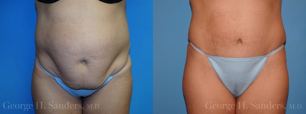 What is a reverse tummy tuck? - Dr. Hess