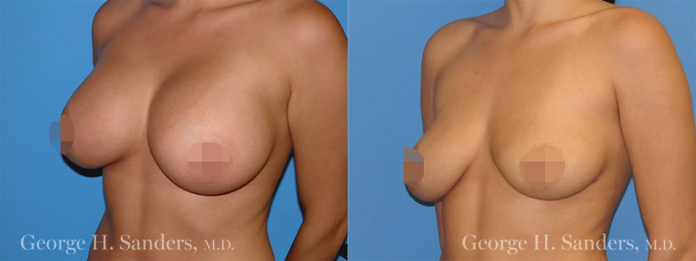 dr-sanders-los-angeles-Breast-implant-removal_patient-1-2_CENSORED