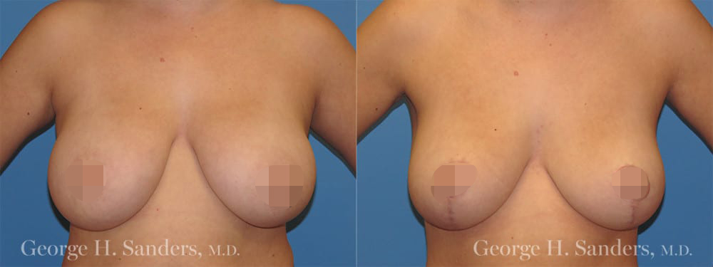 dr-sanders-los-angeles-Breast-reduction_patient-1-1_CENSORED