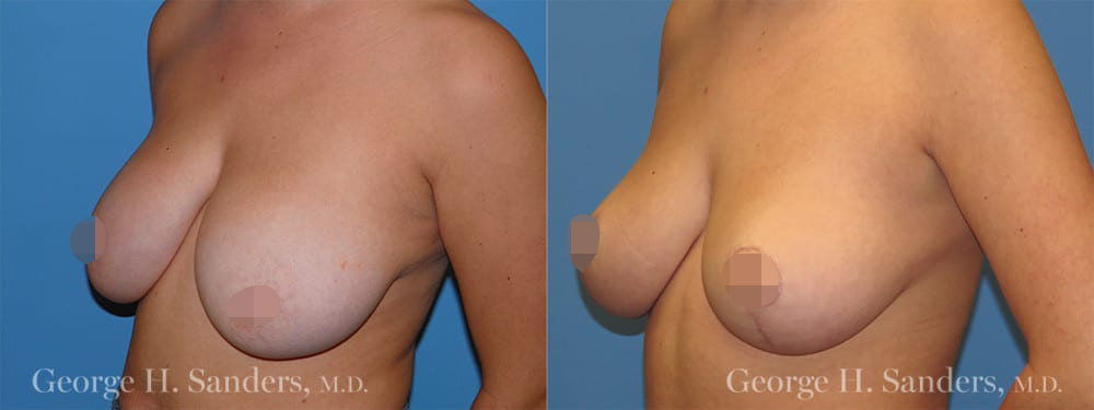 dr-sanders-los-angeles-Breast-reduction_patient-1-2_CENSORED