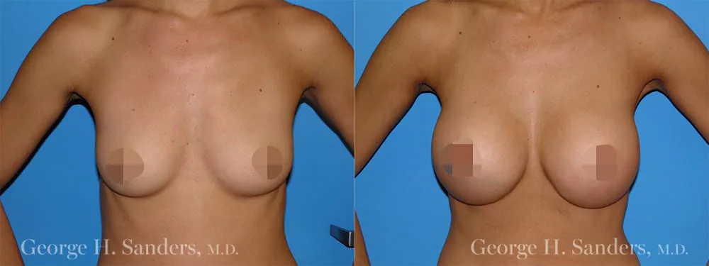 dr sanders los angeles Breast augmentation patient 1 1 CENSORED1