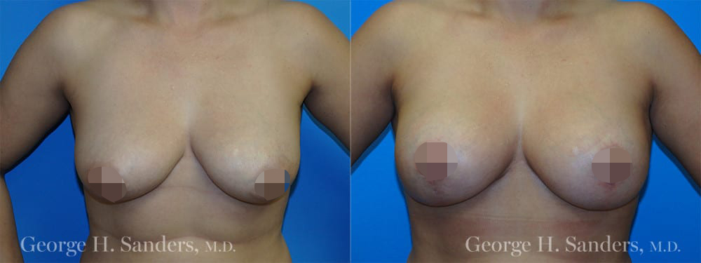 dr-sanders-los-angeles-Full-breast-lift_patient-1-1_CENSORED