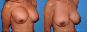 dr-sanders-los-angeles-breast-capsules-patient-16-2