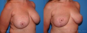dr-sanders-los-angeles-breast-implant-removal-patient-patient-7-3