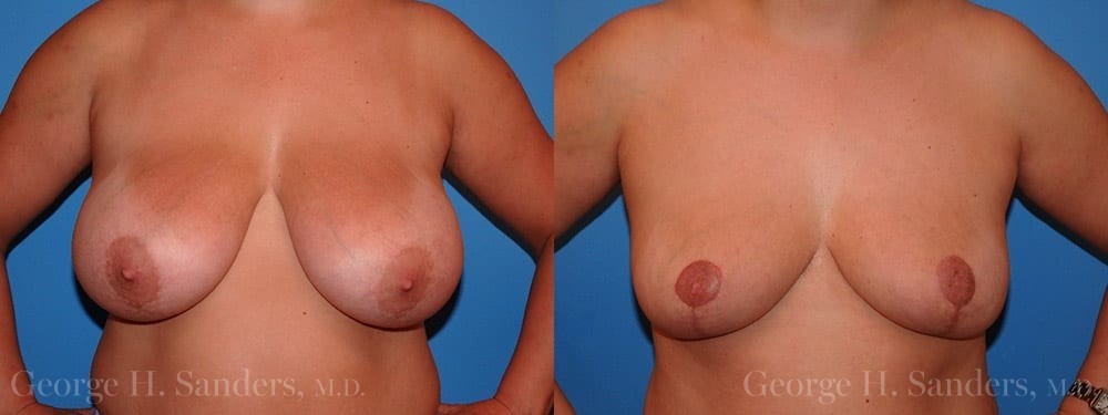dr-sanders-los-angeles-breast-reduction-patient-17-1