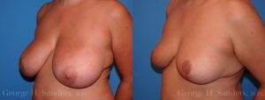 dr-sanders-los-angeles-breast-reduction-patient-17-2