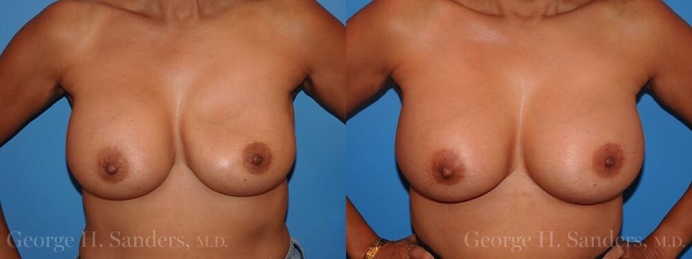 dr-sanders-los-angeles-breast-capsulectomy-patient-18-1