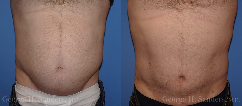 dr-sanders-san-fernando-valley-male-liposuction-patient-2-1