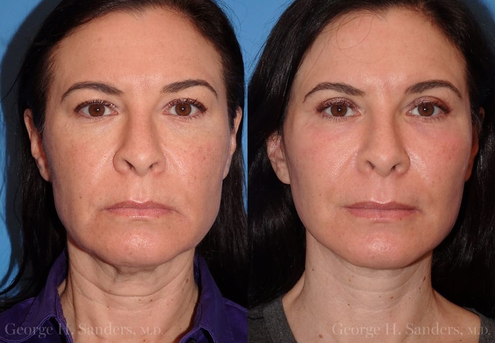 Patient 2a Face Lift Before and After