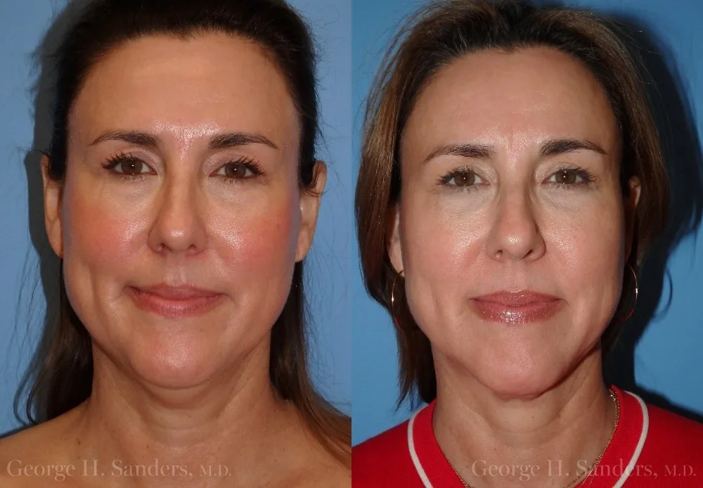 Patient 16a Face Lift Before and After