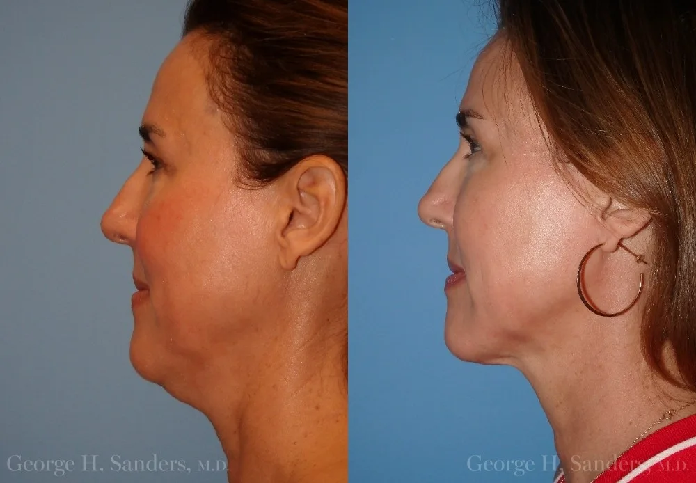 Patient 16b Face Lift Before and After